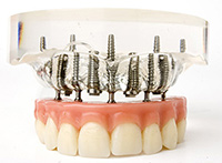 implant supported dentures